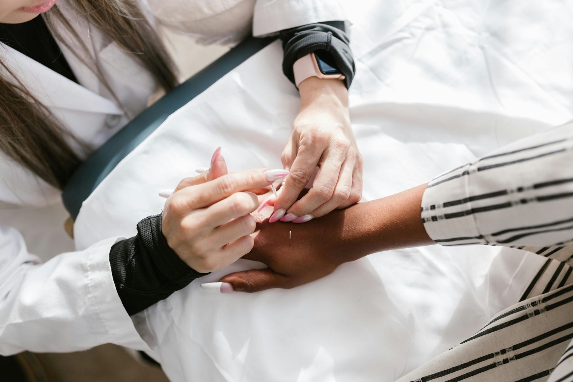 acupuncture on hand