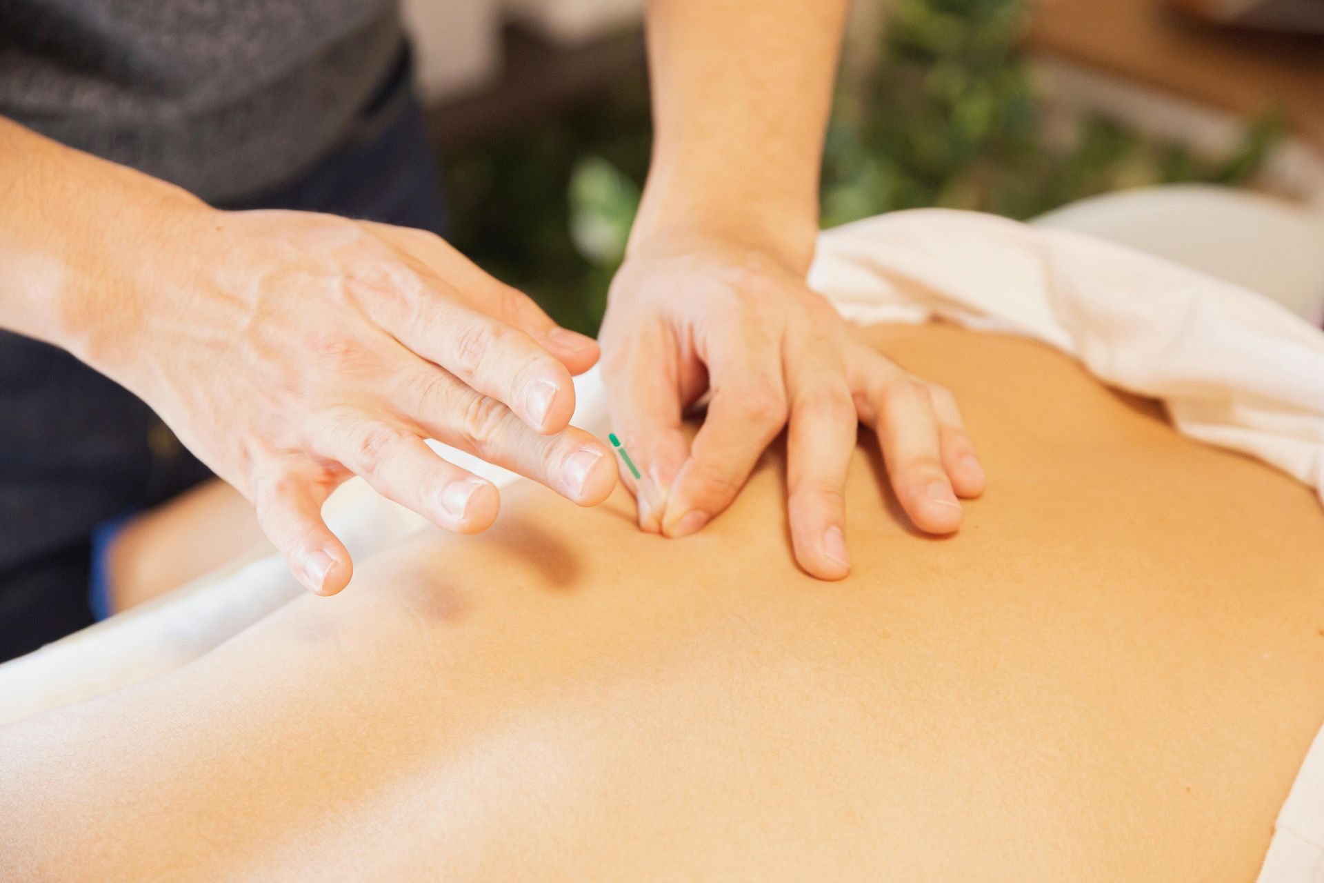 acupuncture needles being inserted into back