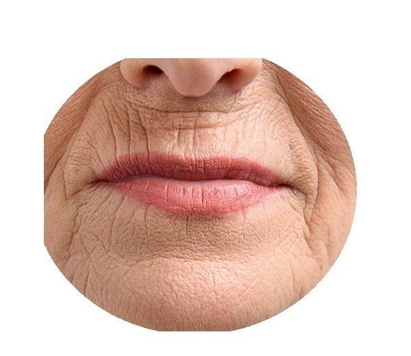 tratamiento arrugas del labio alpedrete, guadarrama, el escorial, navacerrada, collado villalba