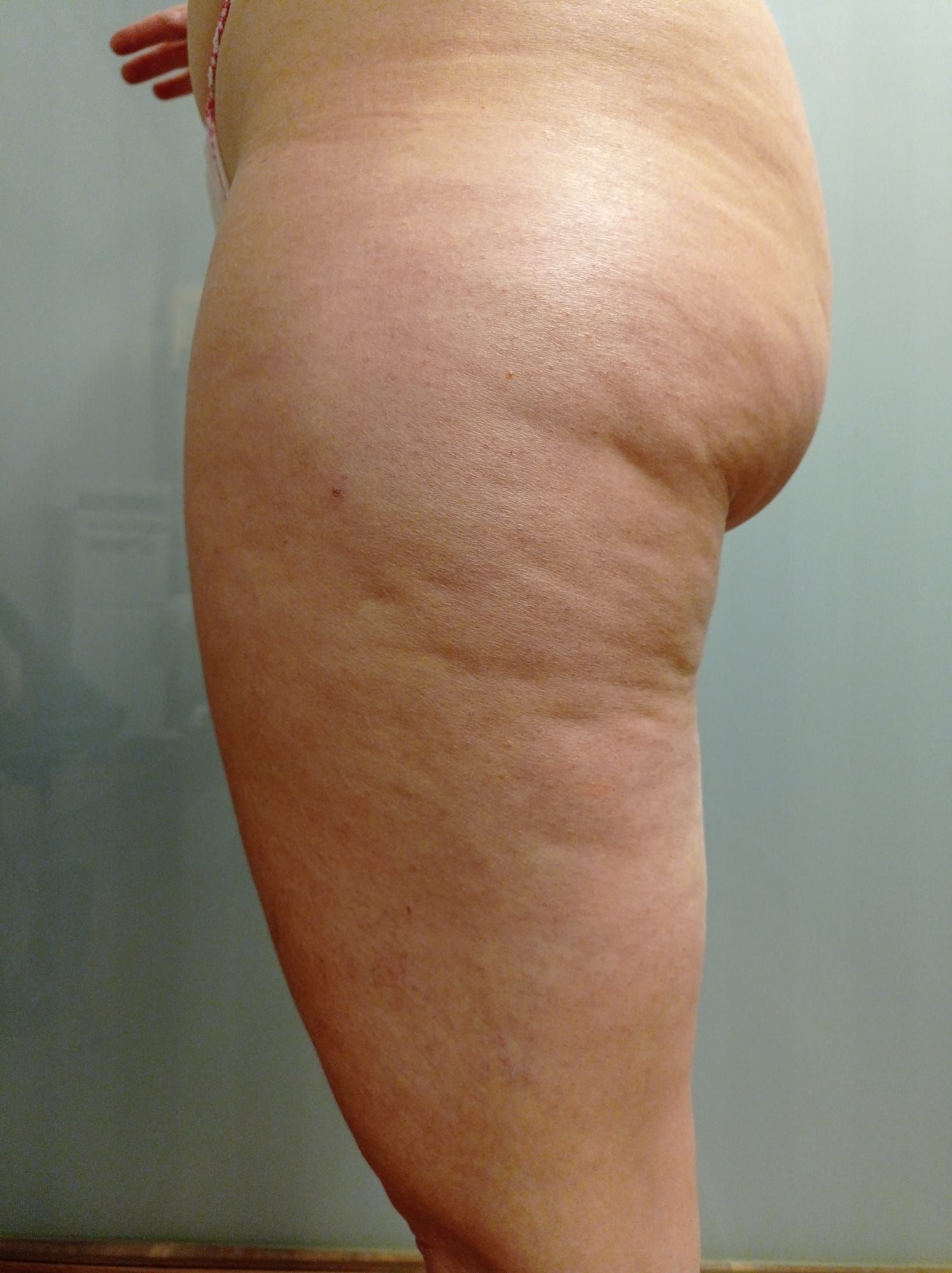 Reafirmación piel Indiba