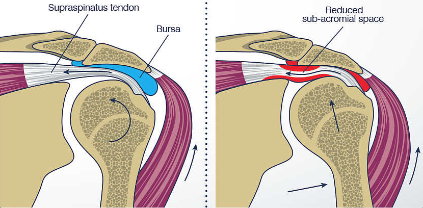 Sindrome Subacromial, Fisioterapia 2002 Síndrome Subacromial, Málaga, Teatinos, espolon, fascitis