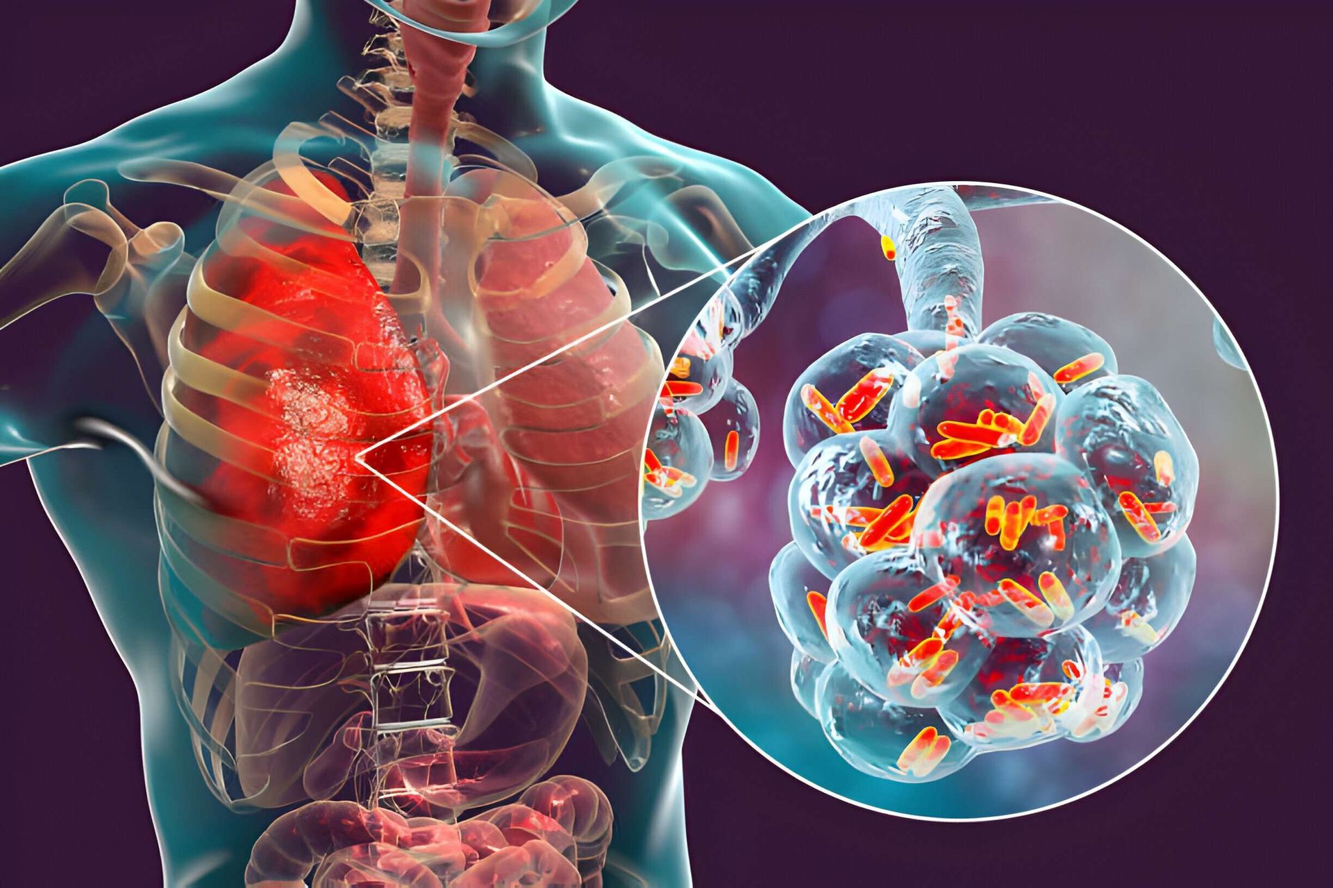 Transmisión de la legionella Transmisión de la legionella