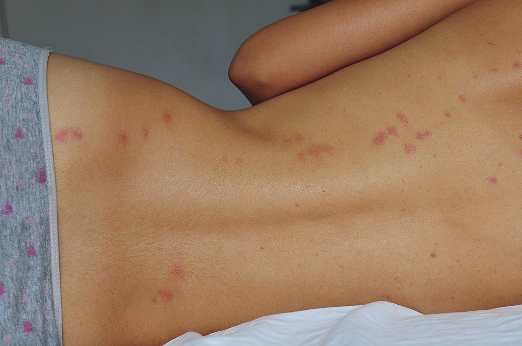 Picaduras de chinches de la cama Picaduras de chinches de la cama