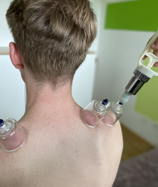 Schröpfen eines Patienten in der Physiotherapie