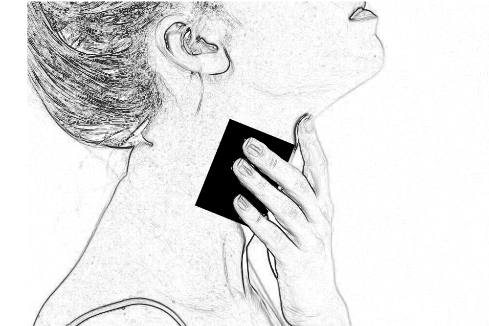 ardoise sur la sphere ORL suite à une radiothérapie