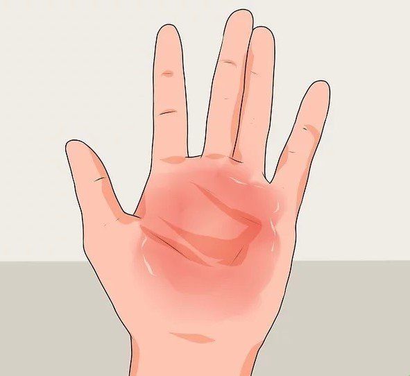 brulure sur la paume ddes mains