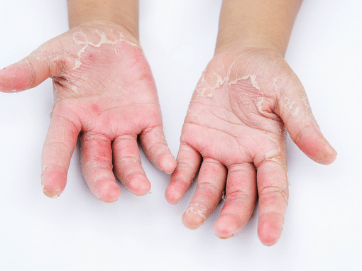 3 astuces pour soulager le Syndrome main pied