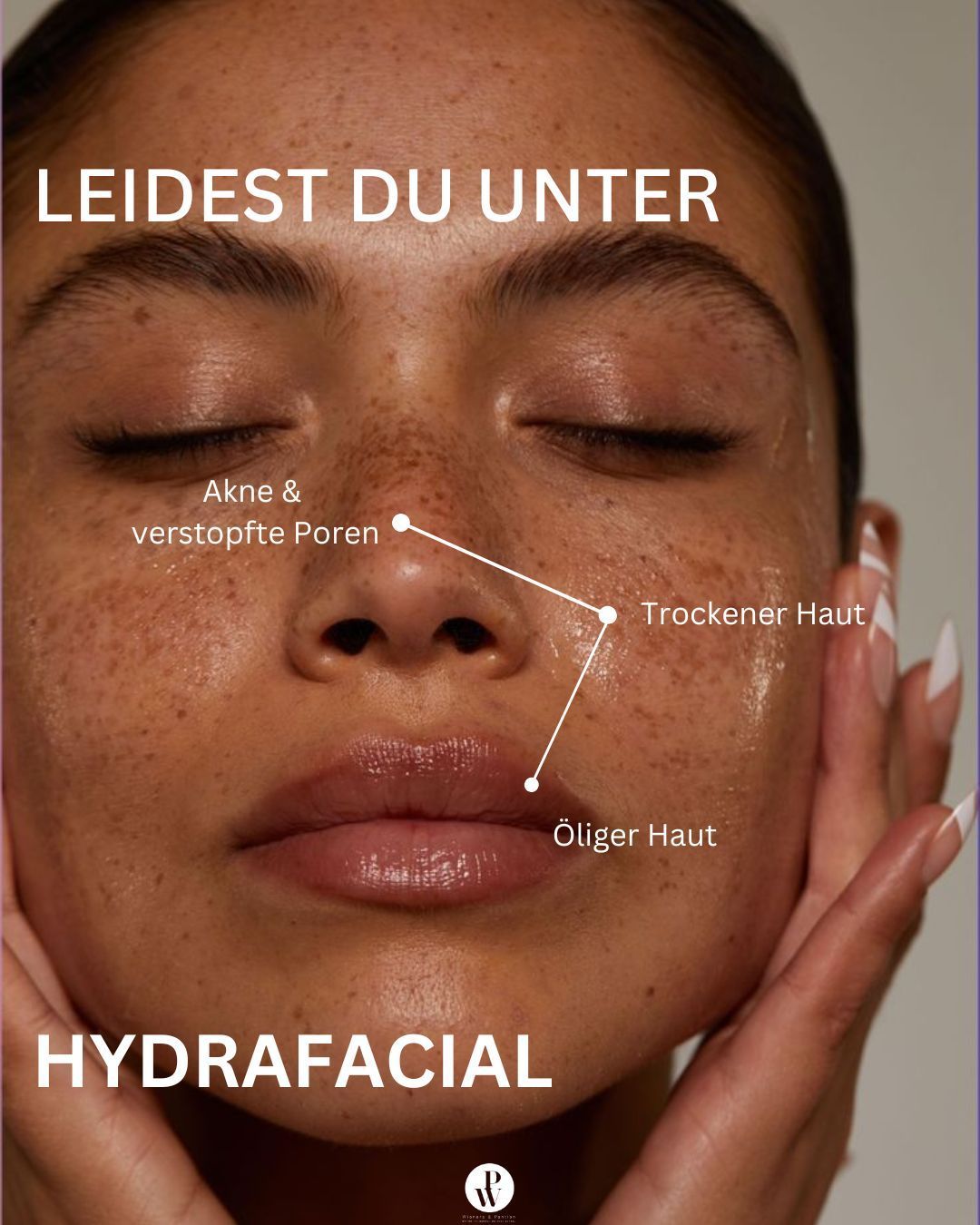 Mit Hyaluronsäure zu einem jugendlicherem Aussehen - Wieners und Pantlen Berlin Hyaluronsäure Behandlung in Berlin bei Wieners und Pantlen