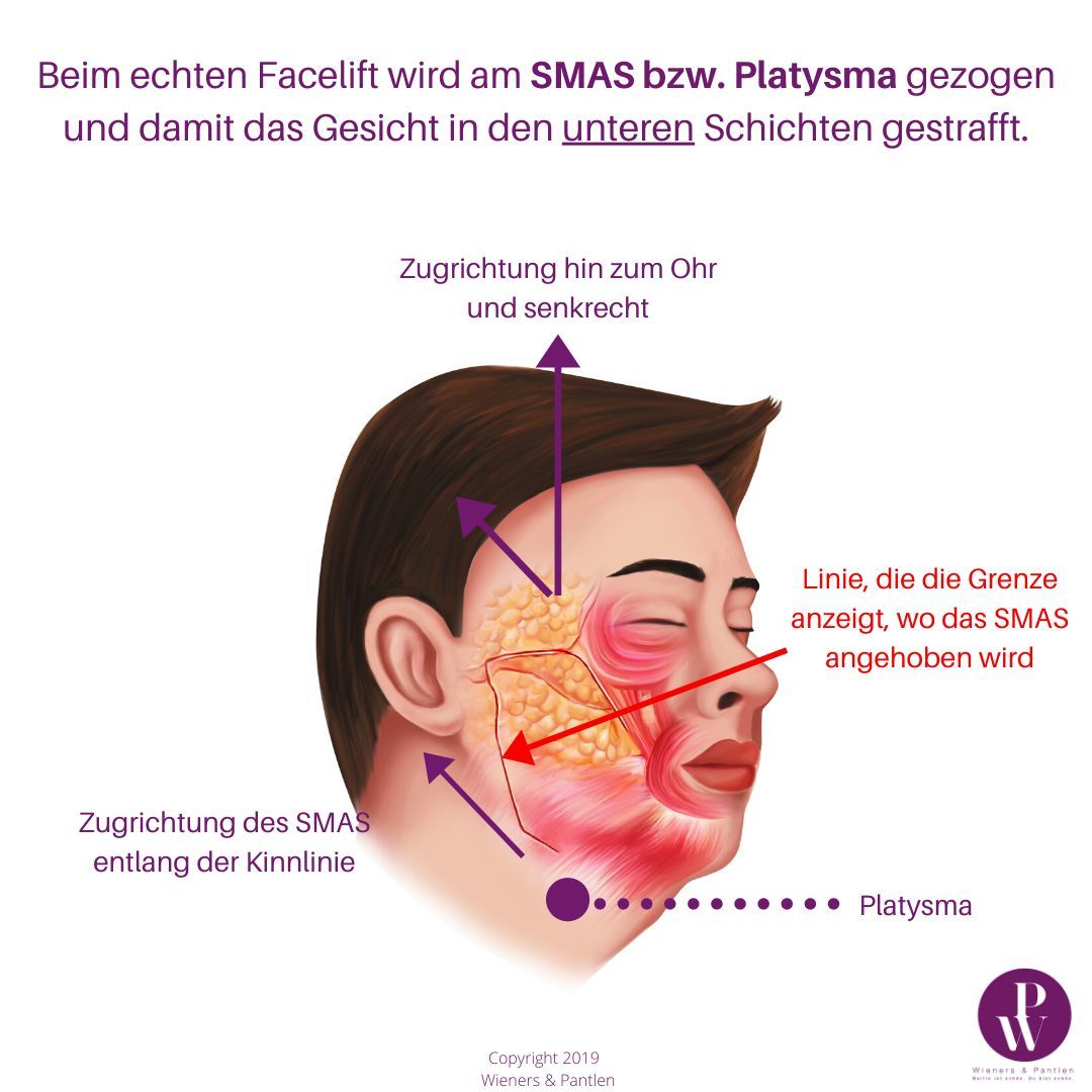 Echtes SMAS Facelift Illustration eines echten SMAS Facelift