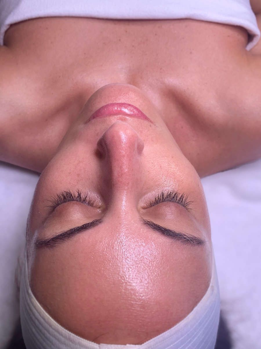 Mit Hyaluronsäure zu einem jugendlicherem Aussehen - Wieners und Pantlen Berlin Hyaluronsäure Behandlung in Berlin bei Wieners und Pantlen