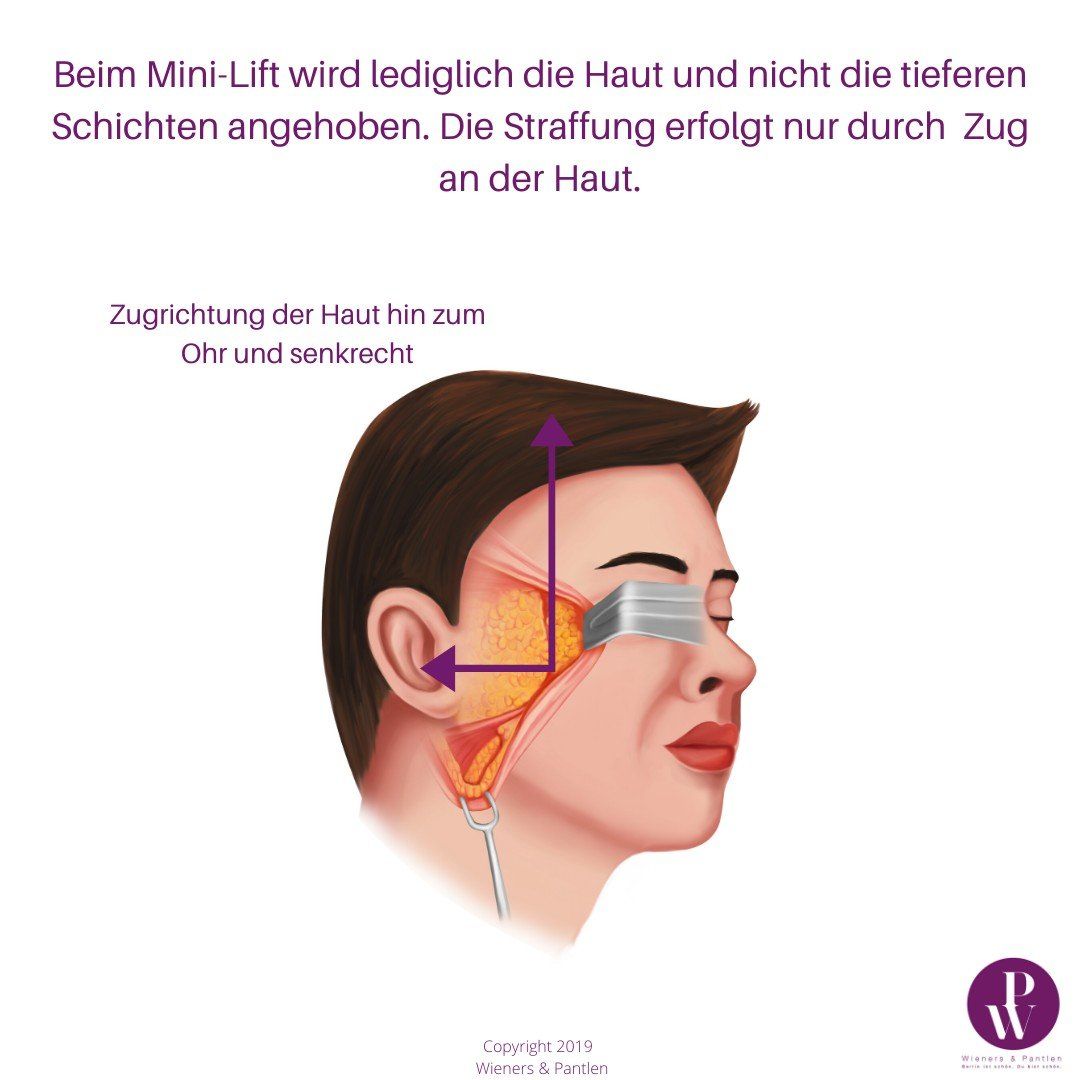 Illustration eines Mini-Facelifts beziehungsweise eines Soft-Facelifts Illustration eines Mini-Facelifts beziehungsweise eines Soft-Facelifts