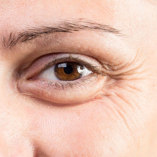 Unterlidstraffung Berlin bei Wieners und Pantlen