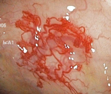 Gutartige Gefäßmissbildung