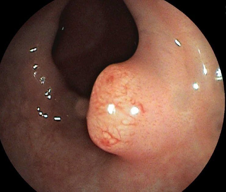 Polyp im Mastdarm (gutartiger Tumor)