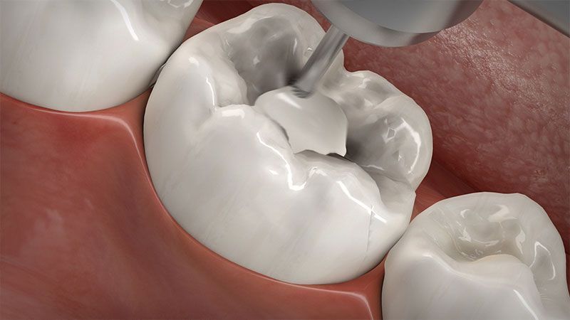 Konservierende Zahnheilkunde