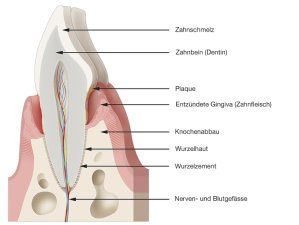 parodontal erkrankter Zahn