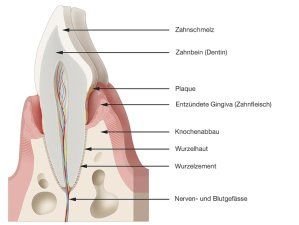 parodontal erkrankter Zahn parodontal erkrankter Zahn