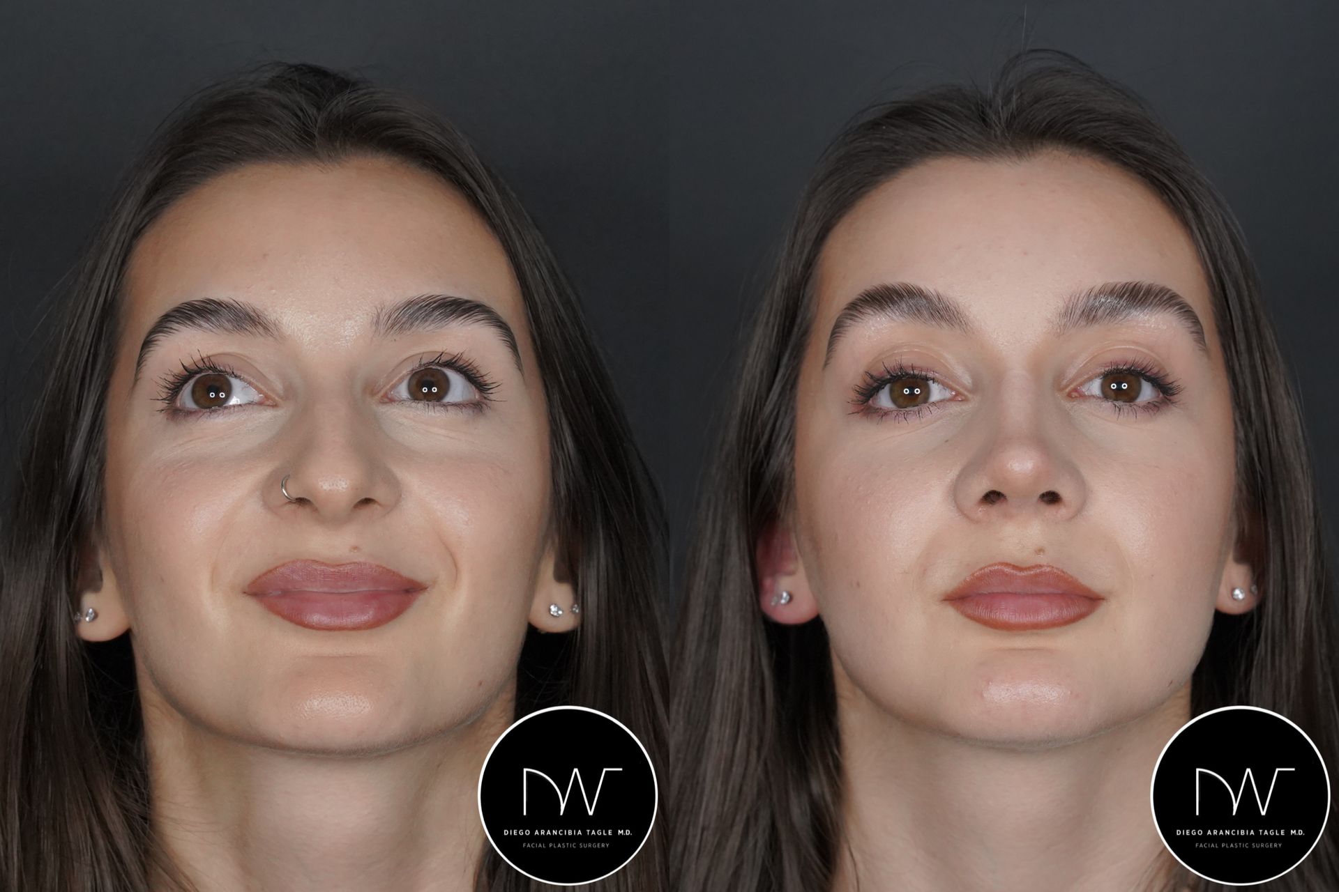 RINOPLASTIA ULTRASONICA ANTES Y DESPUES