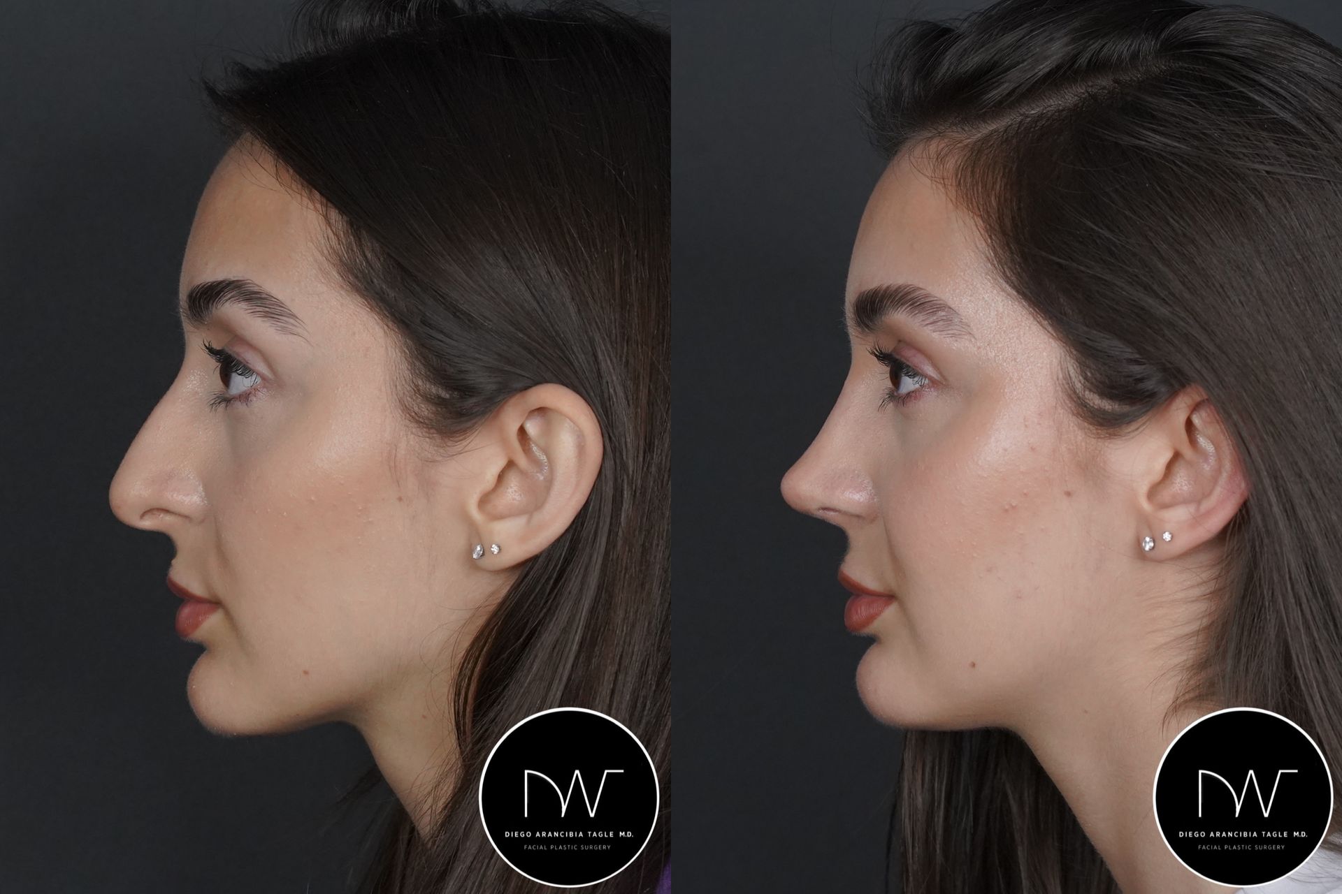 RINOPLASTIA ULTRASONICA ANTES Y DESPUES