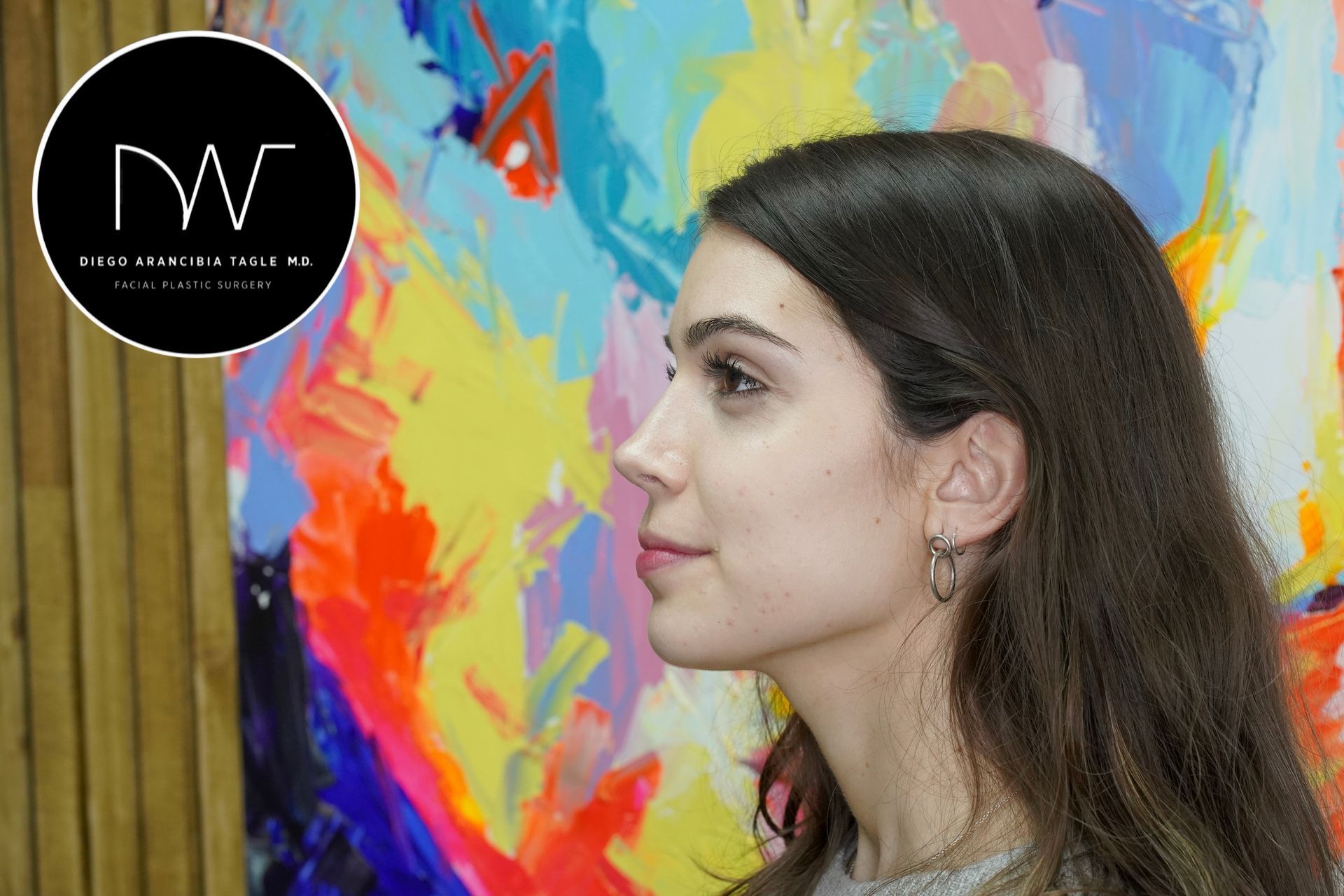 RINOPLASTIA ULTRASONICA ANTES Y DESPUES