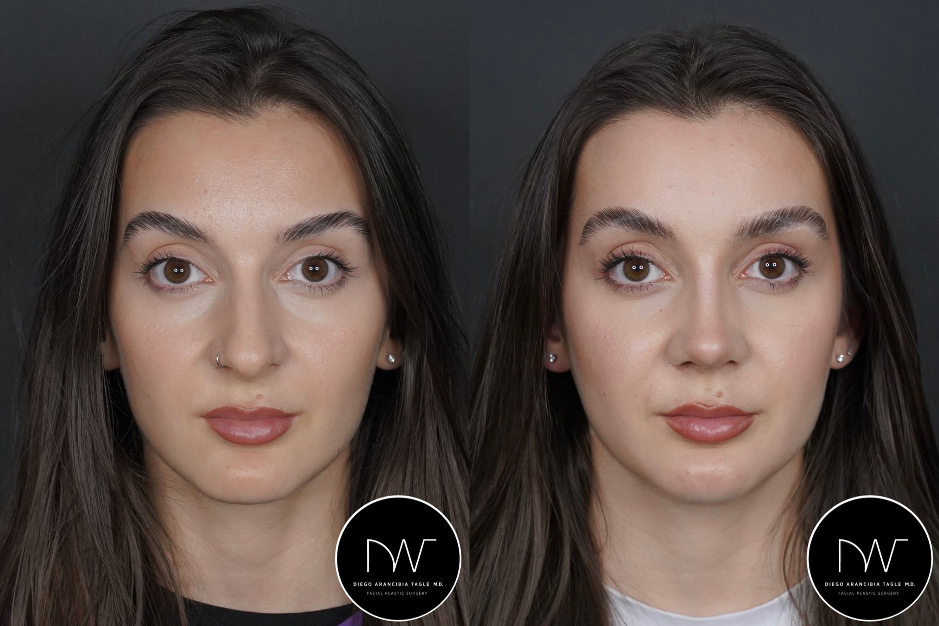 RINOPLASTIA ULTRASONICA ANTES Y DESPUES