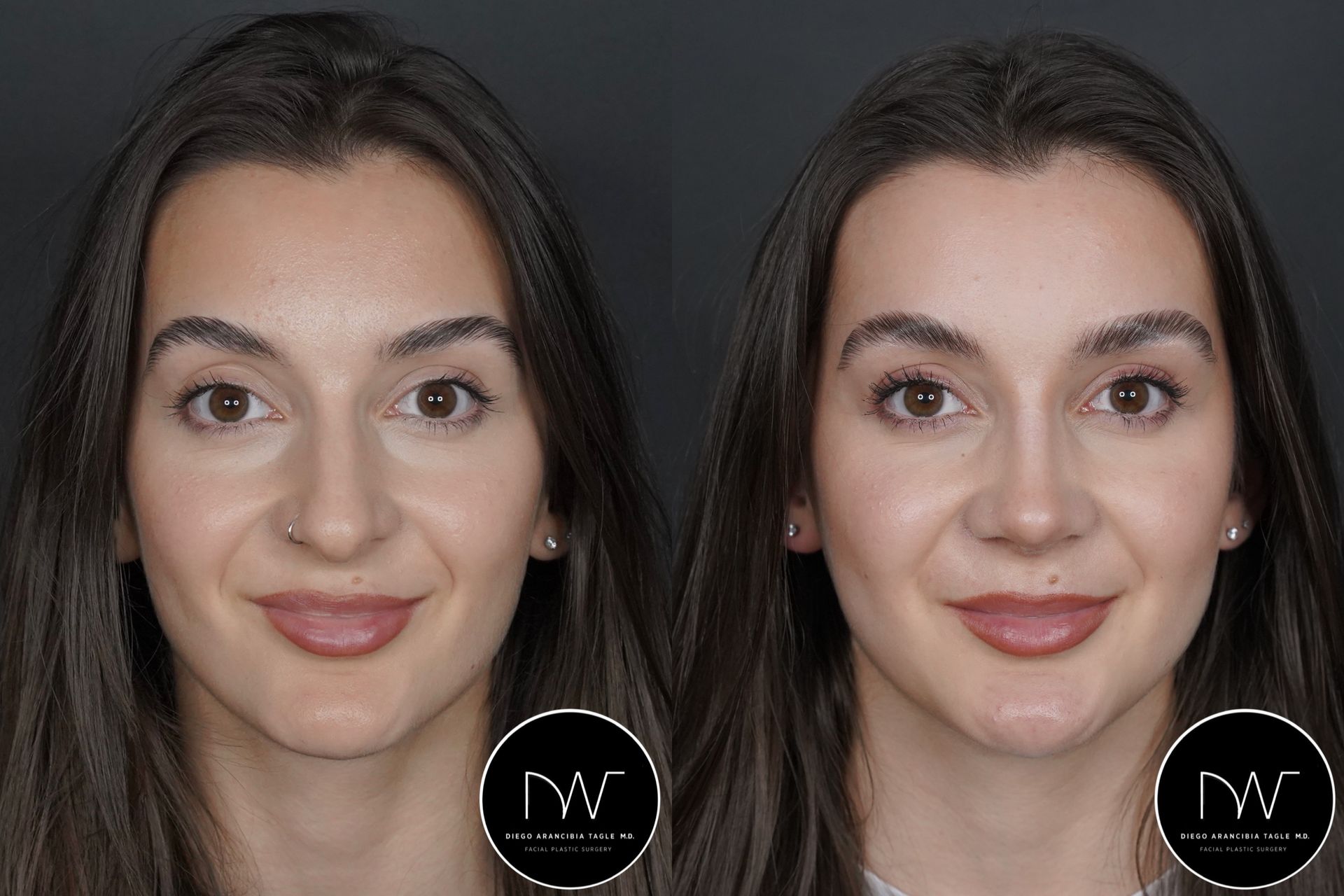 RINOPLASTIA ULTRASONICA ANTES Y DESPUES