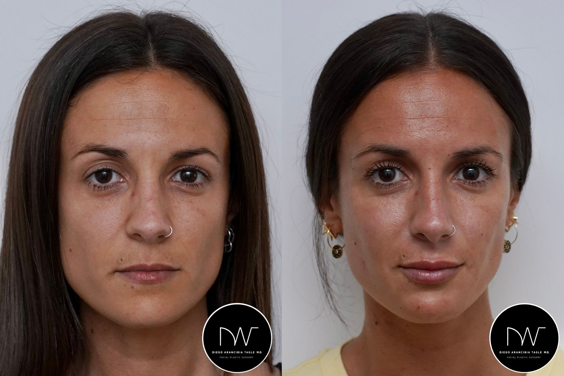Botox + Ácido Hialurónico labios