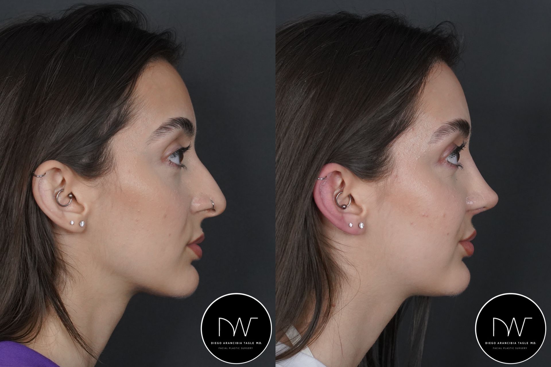 RINOPLASTIA ULTRASONICA ANTES Y DESPUES