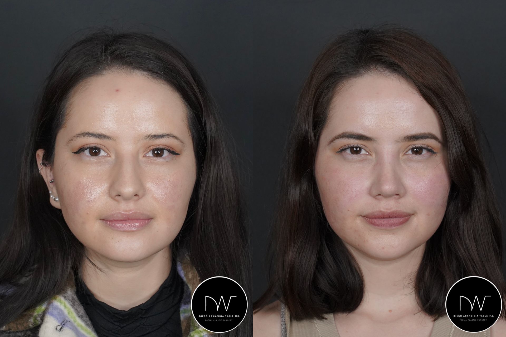 RINOPLASTIA ESPAÑA