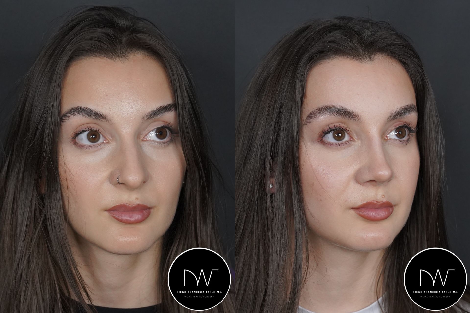 RINOPLASTIA ULTRASONICA ANTES Y DESPUES