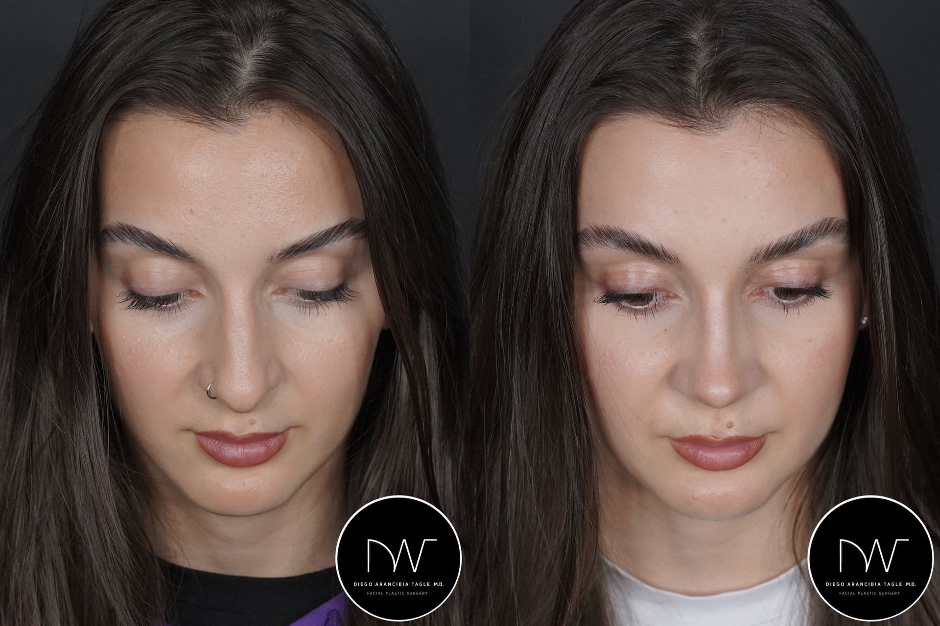 RINOPLASTIA ULTRASONICA ANTES Y DESPUES