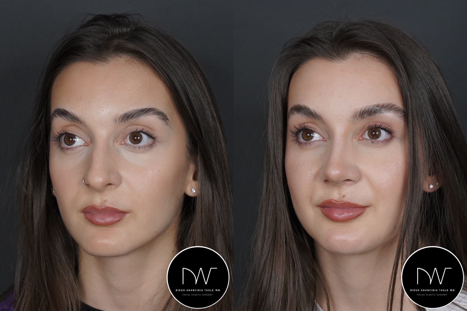 RINOPLASTIA ULTRASONICA ANTES Y DESPUES