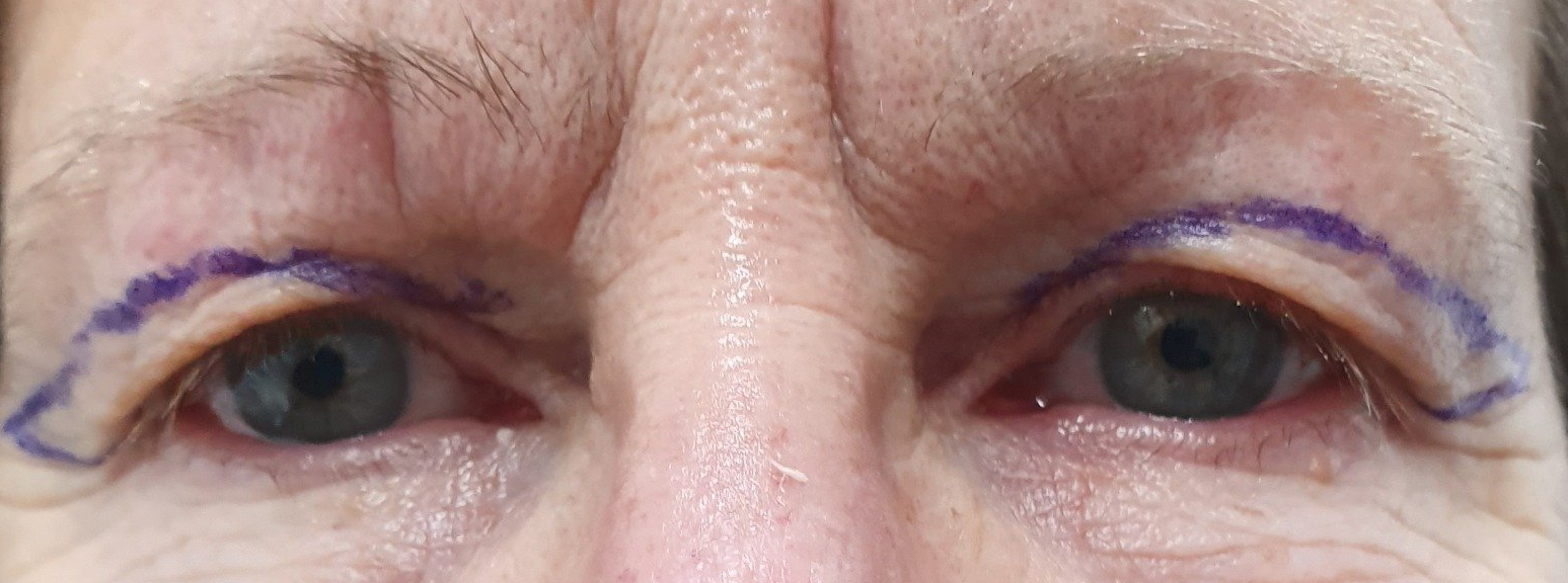 Anzeichnung Anzeichnung