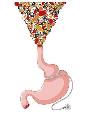 Hypnotisches Magenband zur Gewichtsreduzierung Hypnotisches Magenband zur Gewichtsreduzierung