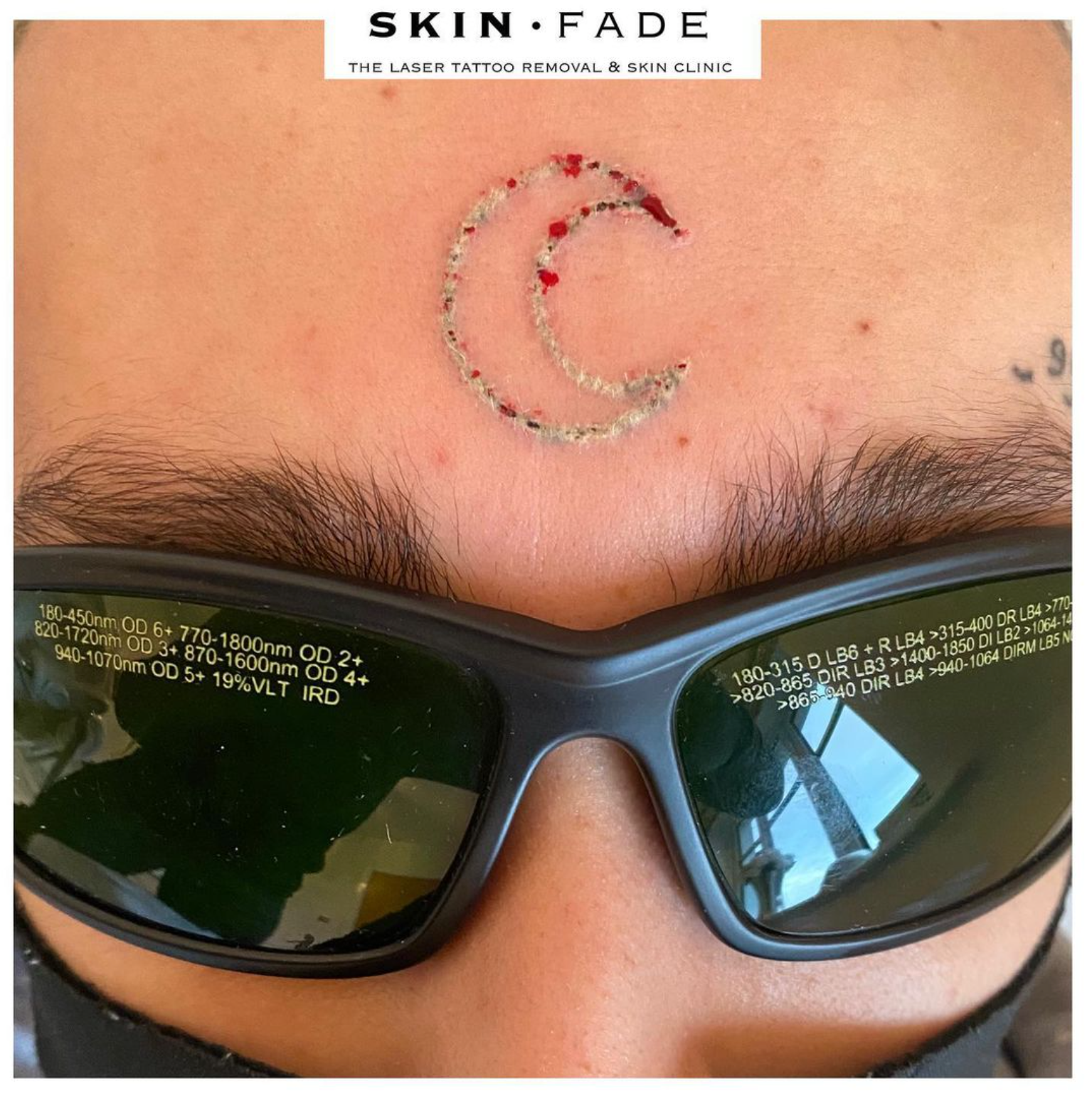 Example of laser tattoo removal pinpoint bleeding