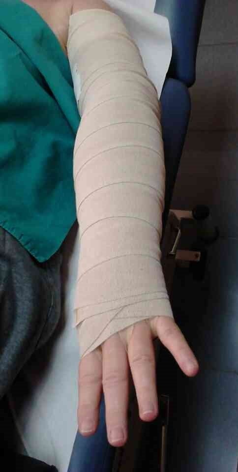 Tratamiento de linfedema en miembro superior combinando kinesiotaping y venda compresiva