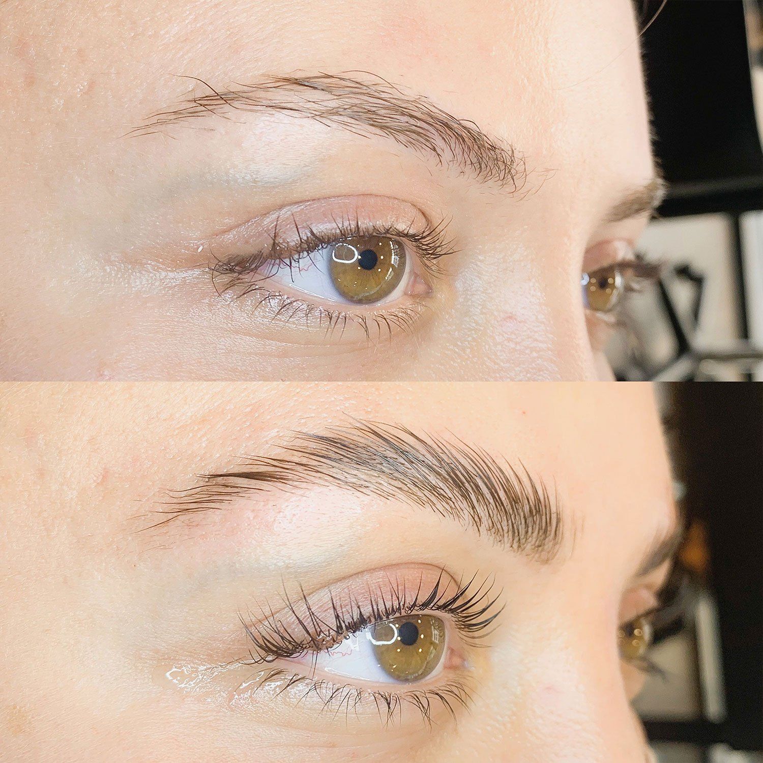 Brow Lifting Brow Lifting