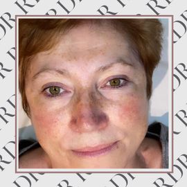 Client Before Microblading Treatment.