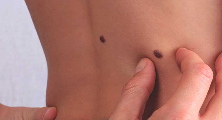 Skin tags