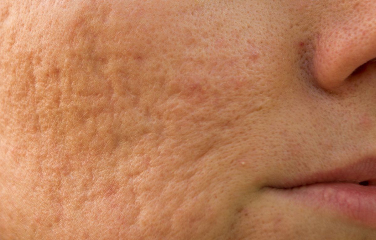Acne scar