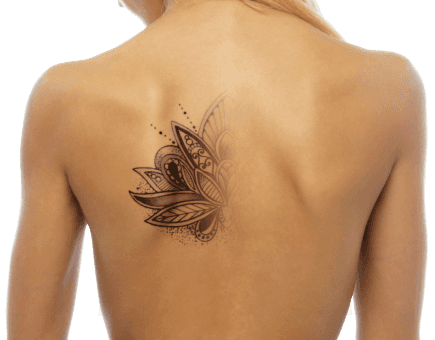 Tattoo laser treatment