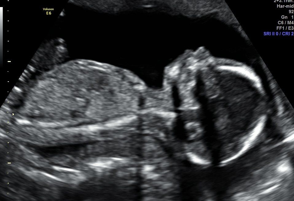elementos condicionan resultado de ecografia 5d liquido amniotico calidad cantidad