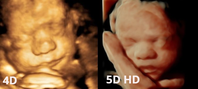 Diferencias ecografia 4D y 5D