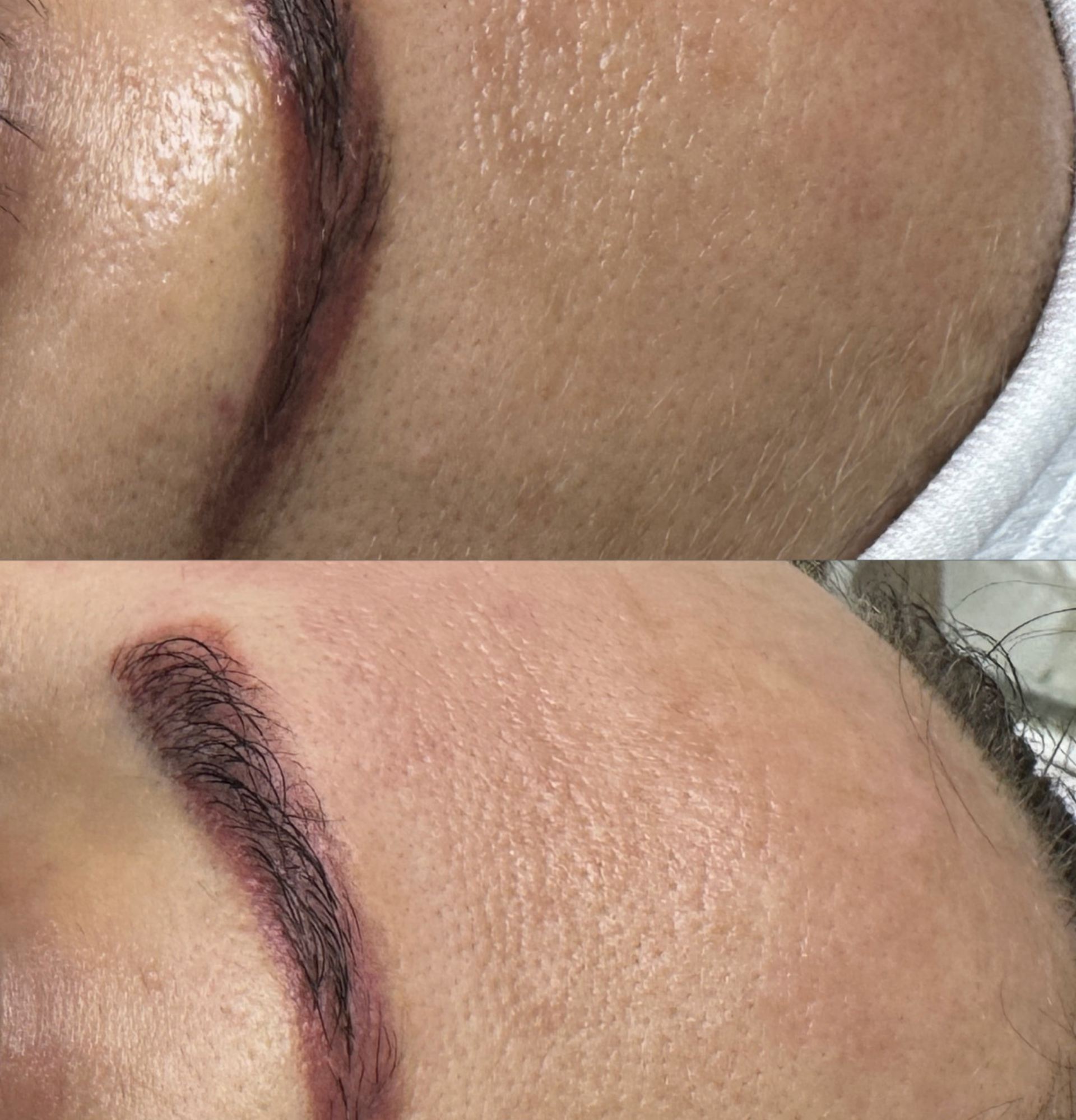 Carbon Peeling Salzburg