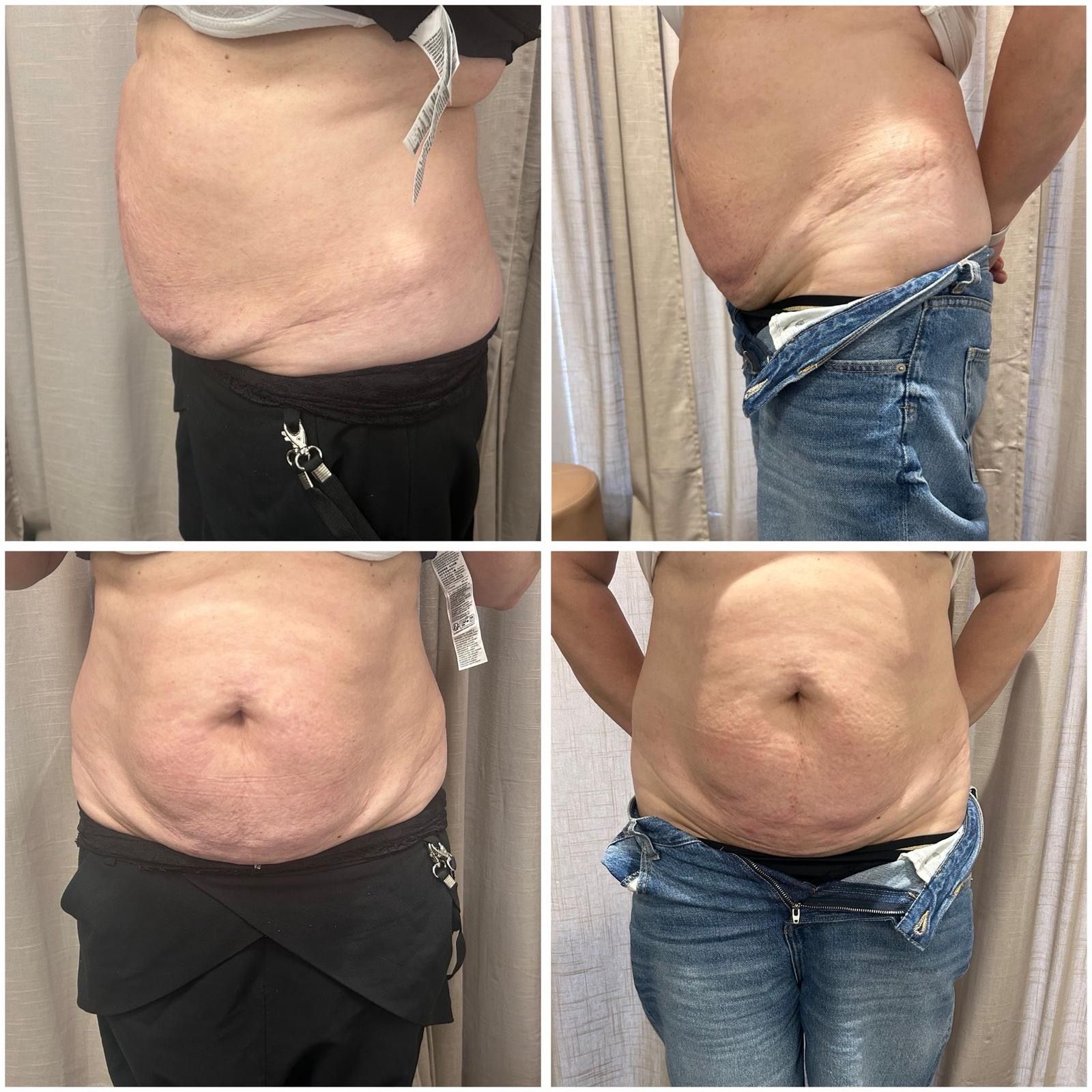 Lipo Slim