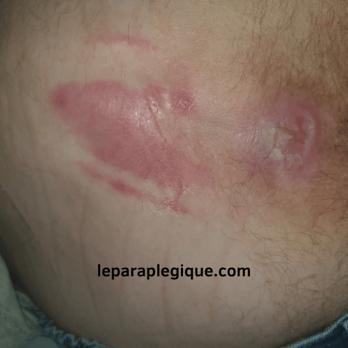 Photo d'une Escarre sacrée - Stade 1 et 3