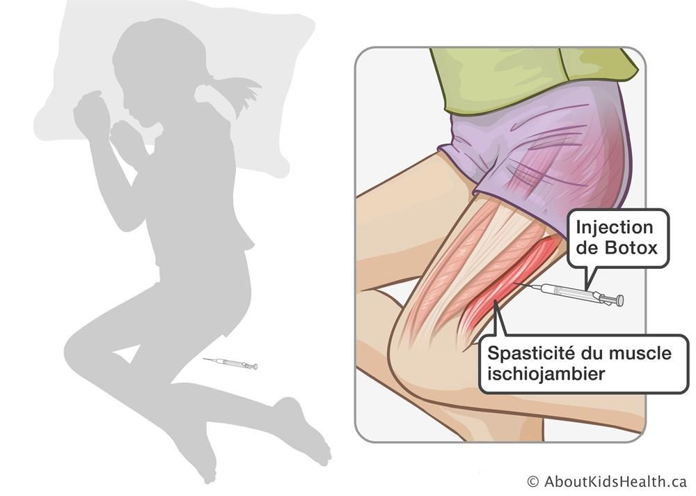 Illustration d'une injection de botox contre la spasticité Illustration d'une injection de botox contre la spasticité