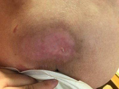 Dermabrasion Ceci est une image d'illustration de dermabrasion