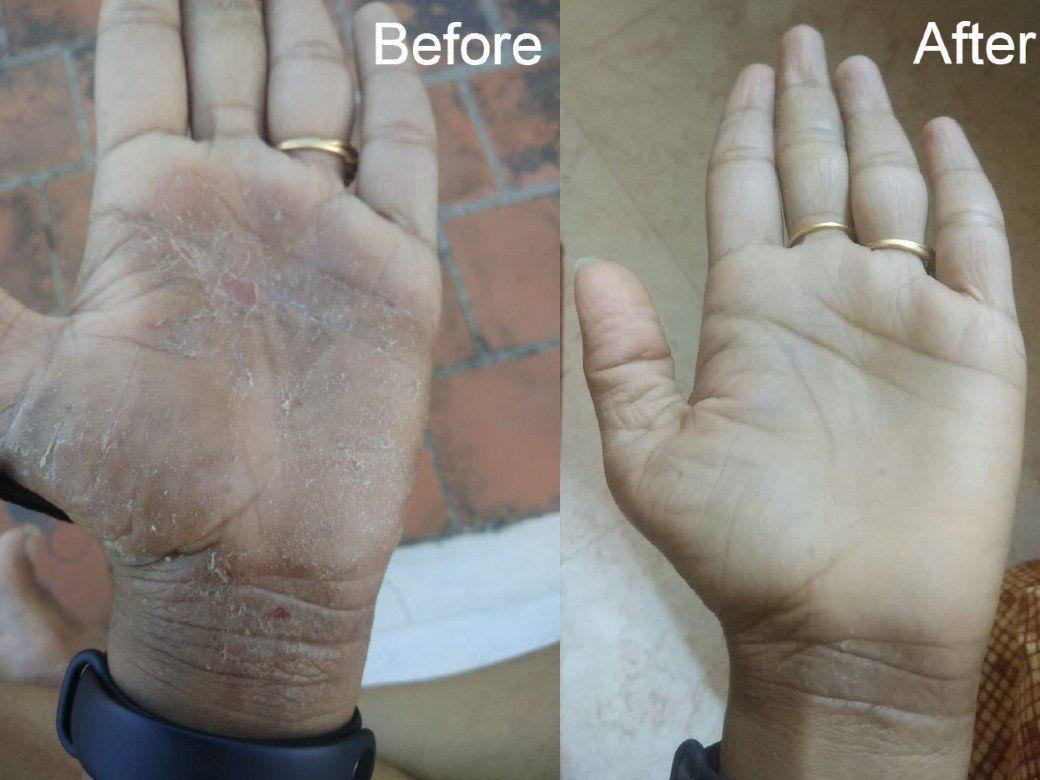 Eczema