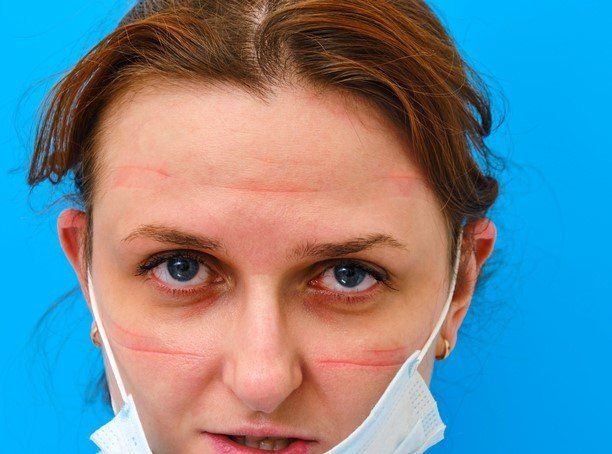 Femme avec le visage meurtri par le port du masque